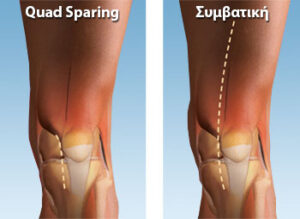 Τεχνικές Ελάχιστης Επεμβατικότητας Γόνατος