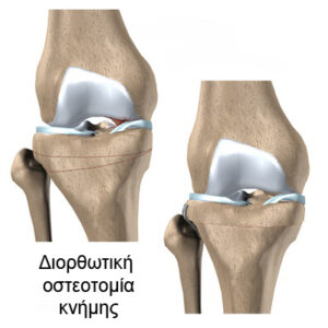 Διορθωτική Οστεοτομία Γόνατος / Κνήμης
