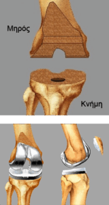 Ολική Αρθροπλαστική Γόνατος