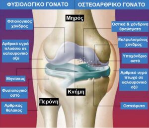 Οστεοαρθρίτιδα