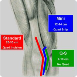 Τεχνική Quad Spearing